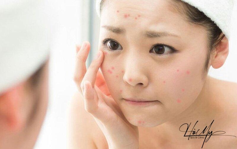 9 cách điều trị mụn trứng cá tuổi dậy thì an toàn và hiệu quả 8 Rửa mặt khi mỗi ngày để giảm mụn trứng cá (Nguồn: Internet)