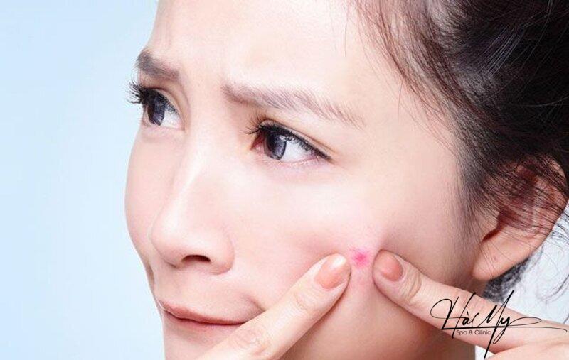 9 cách điều trị mụn trứng cá tuổi dậy thì an toàn và hiệu quả 9 Sinh hoạt một cách khoa học để giảm mụn trứng cá (Nguồn: Internet)