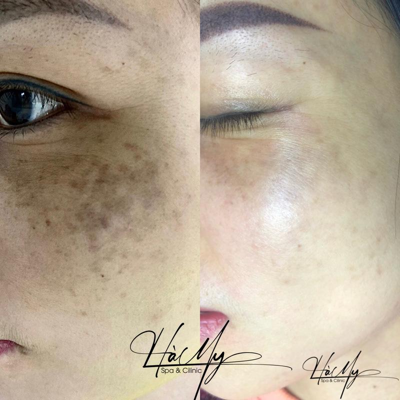 Cách điều trị nám chân sâu tại Spa 10 Hà My Spa là một trong những địa chỉ trị nám uy tín chất lượng hàng đầu (Nguồn: Hà My Spa)