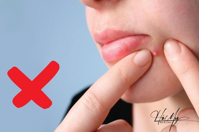 10 cách phòng tránh mụn trứng cá hiệu quả 12 Không nặn mụn khi xuất hiện mụn trứng cá (Nguồn: Internet)