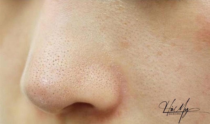 Mụn ẩn ở mũi: Nguyên nhân và cách trị mụn ẩn ở mũi hiệu quả 6 Mụn ẩn ở mũi làm bạn thiếu tự tin (Nguồn: Internet)