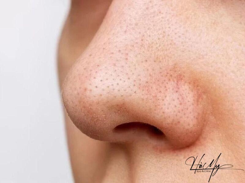 Mụn ẩn ở mũi: Nguyên nhân và cách trị mụn ẩn ở mũi hiệu quả 8 Thường xuyên rửa mặt để giảm mụn ẩn (Nguồn: Internet)
