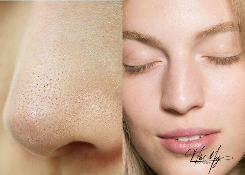 Mụn ẩn ở mũi: Nguyên nhân và cách trị mụn ẩn ở mũi hiệu quả 9 Không nặn mụn ẩn ở mũi (Nguồn: Internet)
