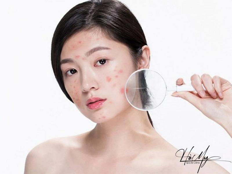 Cách trị mụn nội tiết dứt điểm hiệu quả và an toàn 9 Mụn nội tiết xuất hiện do biến đổi hormone trong cơ thể (Nguồn: Internet)
