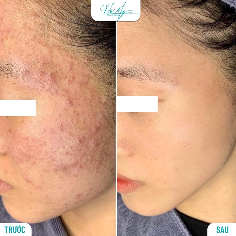 Cách trị mụn nội tiết dứt điểm hiệu quả và an toàn 14 Khách hàng sử dụng dịch vụ điều trị mụn tại Hà My Spa (Nguồn: Hà My Spa)