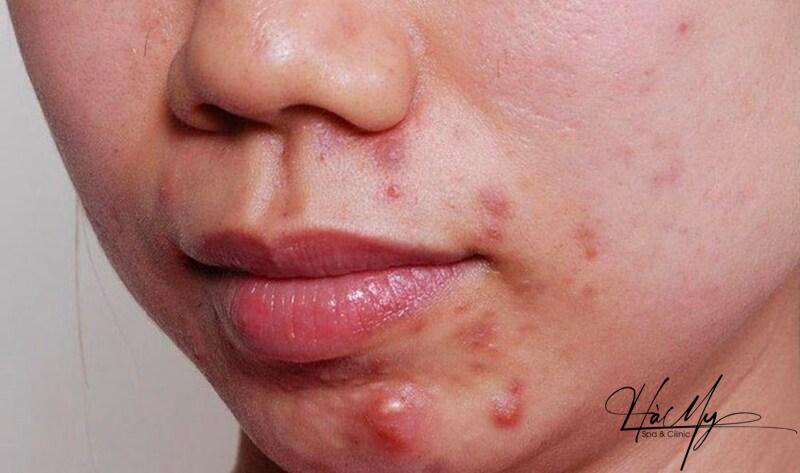 Mách bạn cách trị mụn viêm đỏ đơn giản tại nhà an toàn 9 Những cách trị mụn viêm đỏ (Nguồn: Internet)