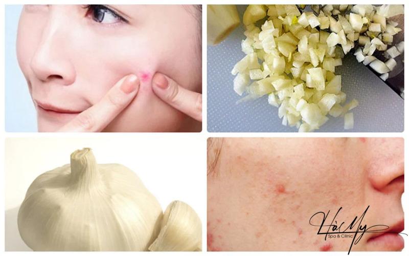 Mách bạn cách trị mụn viêm đỏ đơn giản tại nhà an toàn 12 Cách trị mụn viêm đỏ bằng tỏi (Nguồn: Internet)