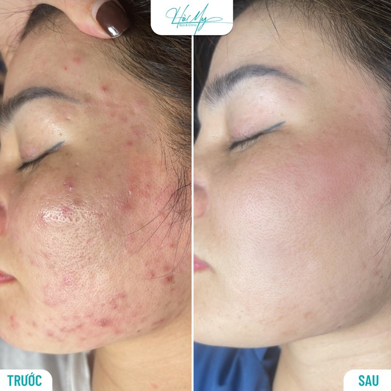 Top 7 cách trị mụn viêm đỏ không nhân tại nhà hiệu quả nhất 20 Khách hàng sử dụng dịch vụ điều trị mụn tại Hà My Spa (Nguồn: Hà My Spa)