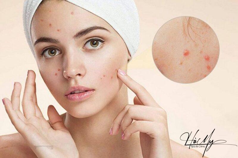Liệu trình trị mụn ẩn ngày và đêm hiệu quả tại nhà 20 Những điều cần lưu ý khi chăm sóc da mụn ẩn (Nguồn: Internet)