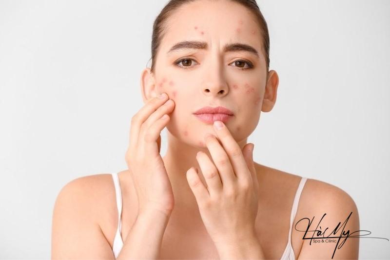 Liệu trình trị mụn ẩn ngày và đêm hiệu quả tại nhà 11 Liệu trình trị mụn ẩn ngày và đêm hiệu quả cho da (Nguồn: Internet)