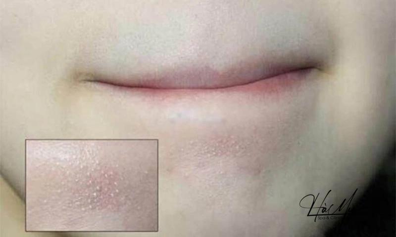 Mụn ẩn dưới cằm: Nguyên nhân và cách điều trị 5 Mụn ẩn thường có màu trắng hoặc vàng nhạt (Nguồn: Internet)