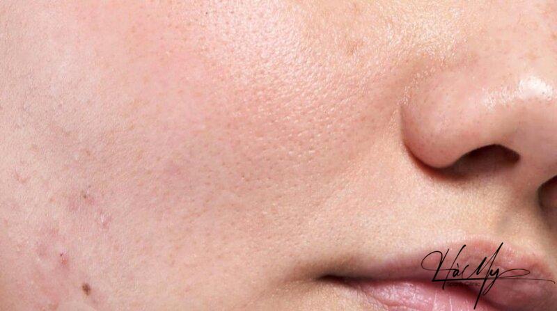 Mụn ẩn dưới cằm: Nguyên nhân và cách điều trị 6 Tẩy tế bào chết loại bỏ mụn ẩn (Nguồn: Internet)