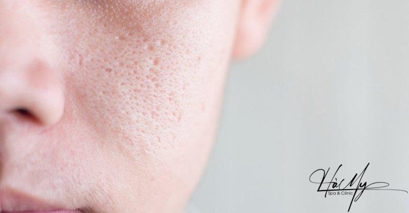 Mụn ẩn dưới cằm: Nguyên nhân và cách điều trị 7 Thường xuyên vệ sinh da mặt để giảm mụn (Nguồn: Internet)