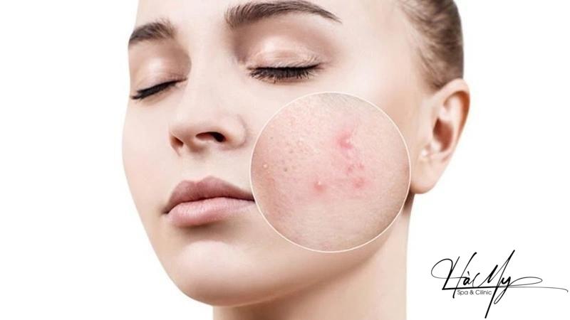 Mụn trứng cá bọc: Nguyên nhân và cách trị hiệu quả 5 Nguyên nhân gây mụn trứng cá bọc trên mặt (Nguồn: Internet)