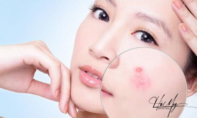 Mụn trứng cá bọc: Nguyên nhân và cách trị hiệu quả 6 Ai cũng có thể nổi mụn trứng cá bọc (Nguồn: Internet)