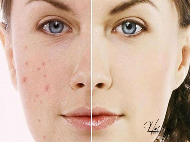 Mụn trứng cá bọc: Nguyên nhân và cách trị hiệu quả 7 Có nhiều phương pháp để trị mụn trứng cá bọc (Nguồn: Internet)