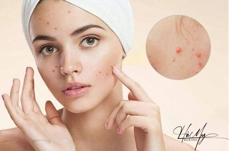 Mụn trứng cá bọc: Nguyên nhân và cách trị hiệu quả 8 Rửa mặt để giảm mụn trứng cá bọc (Nguồn: Internet)