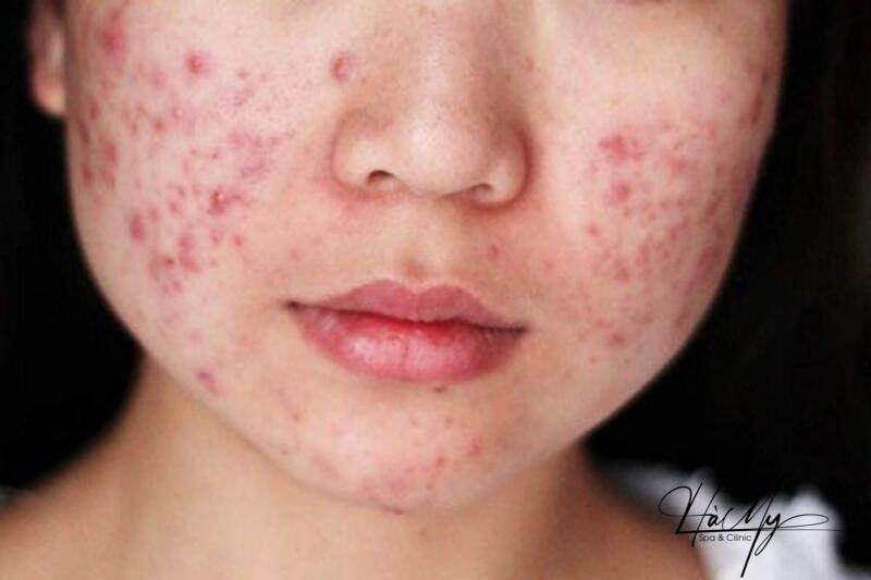 Mụn trứng cá đỏ: Dấu hiệu nhận diện và cách điều trị hiệu quả 8 Mụn trứng cá đỏ là gì? (Nguồn: Internet)