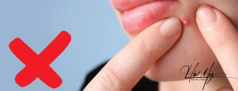 Mụn trứng cá đỏ: Dấu hiệu nhận diện và cách điều trị hiệu quả 12 Tuyệt đối không tự nặn mụn trứng cá đỏ vì dễ gây nhiễm trùng (Nguồn: Internet)