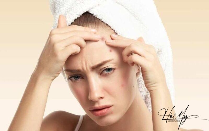 Mụn trứng cá ở trán - Nguyên nhân và cách điều trị triệt để 7 Chăm sóc da không đúng cách làm mụn trứng cá ở trán (Nguồn: Internet)