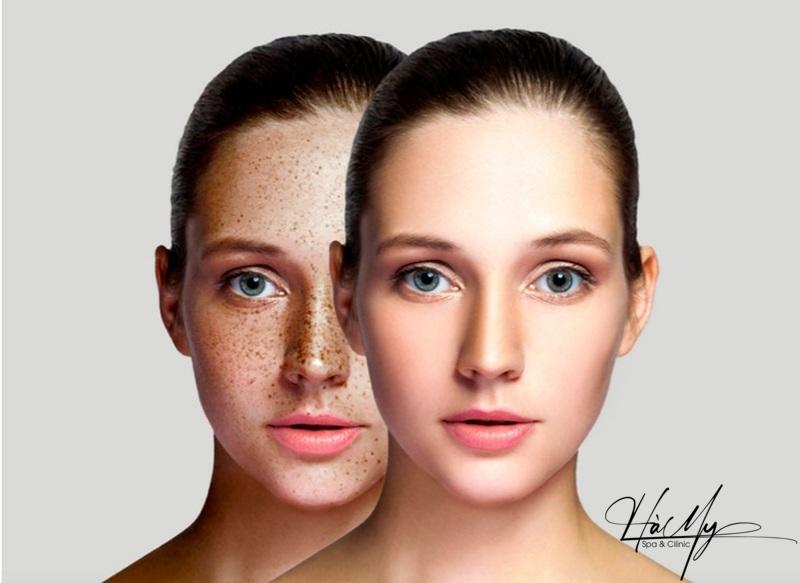 Spa trị nám tàn nhang uy tín ở Hà Tĩnh 5 Điều trị nám giúp khuôn mặt của bạn đẹp hơn (Nguồn: Internet)