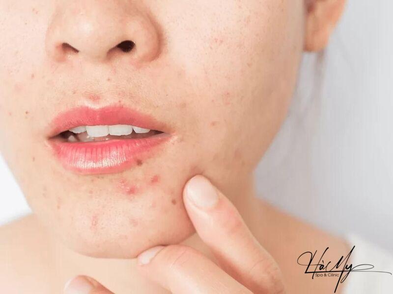 Trị mụn trứng cá ở cằm: Nguyên nhân, triệu chứng và cách phòng ngừa 4 Sự thay đổi của nội tiết tố làm nổi mụn ở cằm (Nguồn: Internet)
