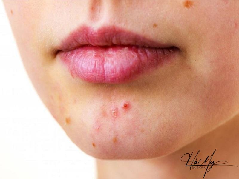 Trị mụn trứng cá ở cằm: Nguyên nhân, triệu chứng và cách phòng ngừa 5 Trị mụn trứng cá ở cằm (Nguồn: Internet)