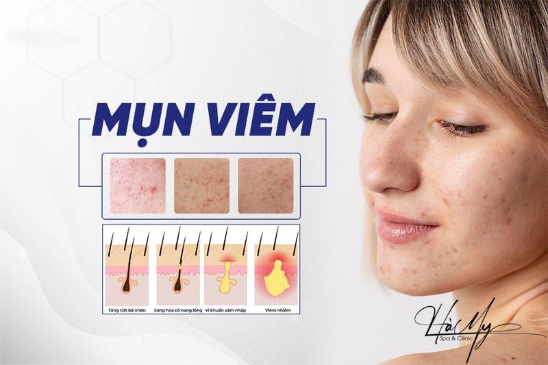 Cách trị mụn viêm bằng phương pháp Y khoa cho làn da bị mụn 5 Mụn viêm dưới da là gì? (Nguồn: Internet)