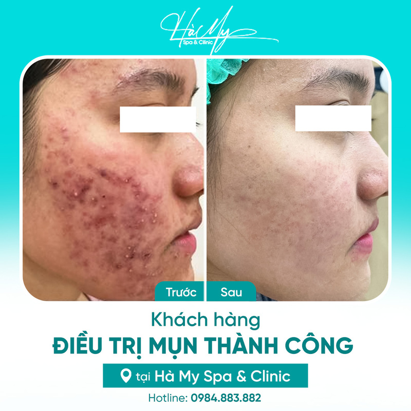 Cách trị mụn viêm bằng phương pháp Y khoa cho làn da bị mụn 8 Khách hàng sử dụng dịch vụ điều trị mụn viêm tại Hà My Spa (Nguồn: Hà My Spa)