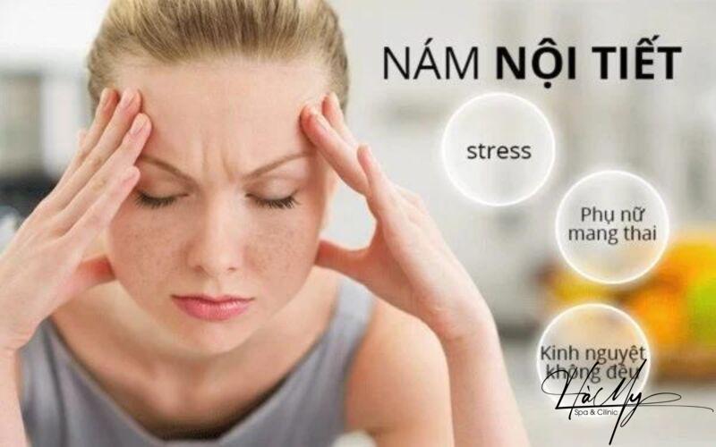 Kinh nghiệm trị nám nội tiết hiệu quả 8 Bị stress, căng thẳng, mất ngủ, hoặc thiếu dinh dưỡng (Nguồn: Internet)