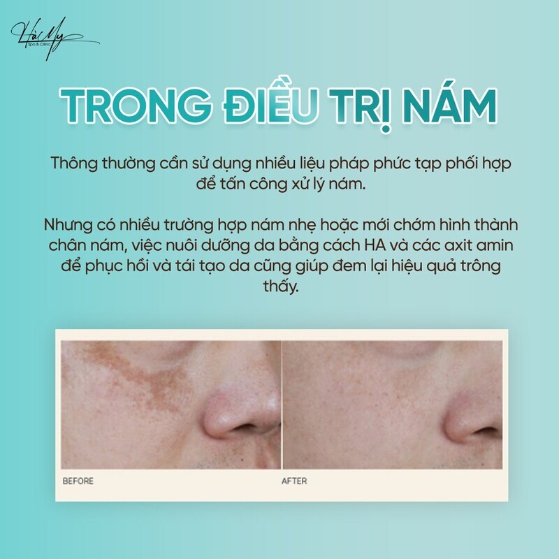 Kinh nghiệm trị nám nội tiết hiệu quả 12 Hà My Spa & Clinic nơi điều trị nám uy tín (Nguồn: Ha My Spa)
