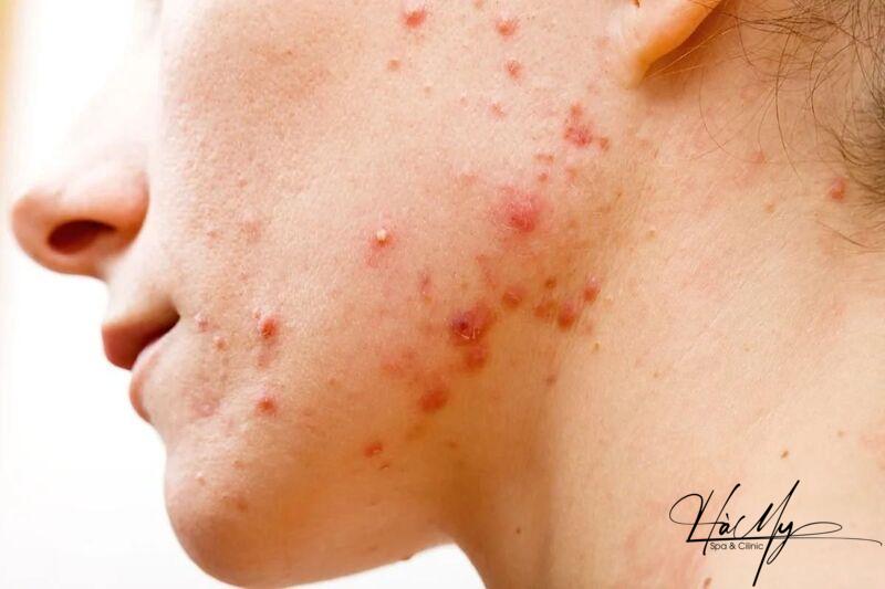 Viêm da mụn mủ: Nguyên nhân và cách chữa trị 6 Viêm da mụn mủ là một bệnh lý da liễu thường gặp (Nguồn: Internet)