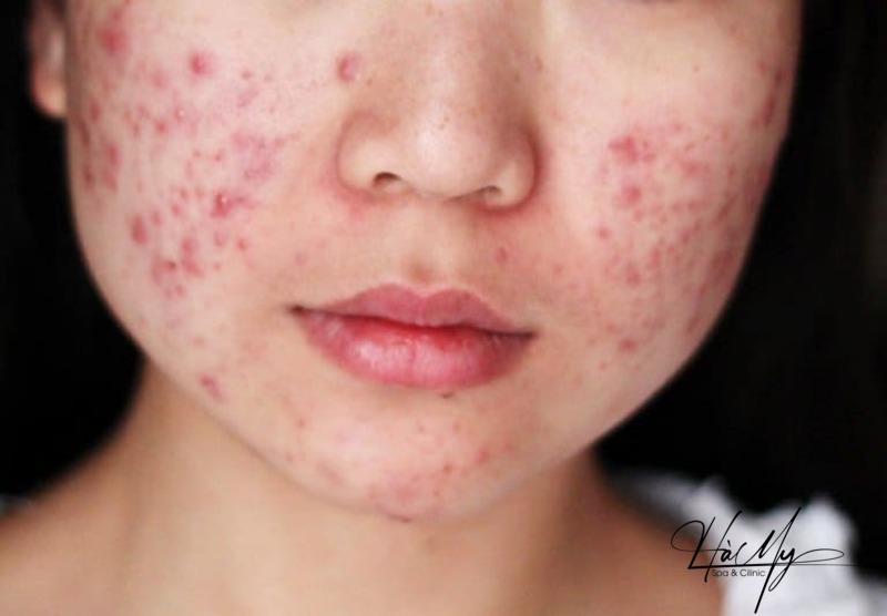 Viêm da mụn mủ: Nguyên nhân và cách chữa trị 7 Ít vệ sinh da có thể gây ra viêm da mụn mủ (Nguồn: Internet)