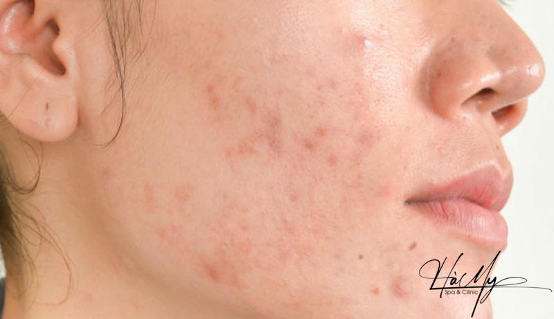 Viêm da mụn mủ: Nguyên nhân và cách chữa trị 8 Mặt là nơi thường xuất hiện viêm da mụn mủ (Nguồn: Internet)