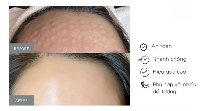 Tiêm BAP và tiêm Meso có gì khác nhau? 5 Tiêm Meso chính là cải thiện độ đàn hồi và tái tạo làn da (Nguồn: Internet)