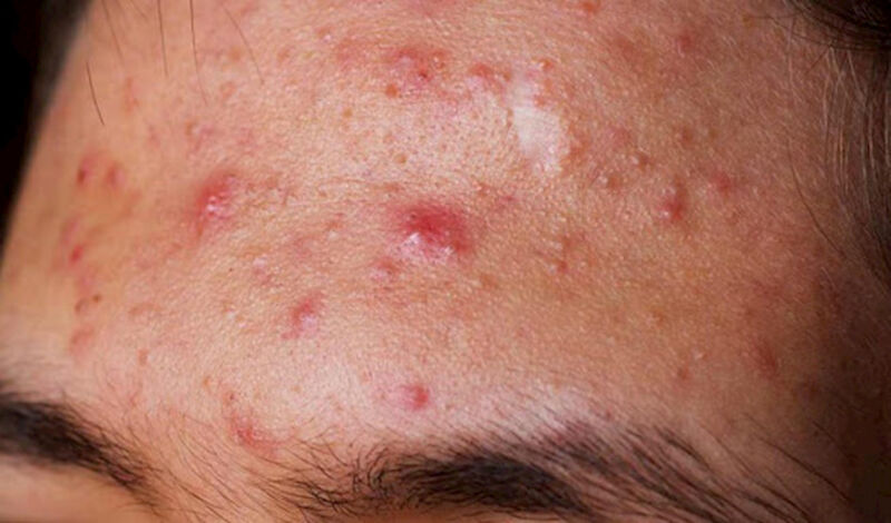 Bật mí 10 cách làm xẹp mụn sưng đỏ sau 1 đêm hiệu quả, an toàn 13 Mụn sưng đỏ là hiện tượng gì? (Nguồn: Internet)