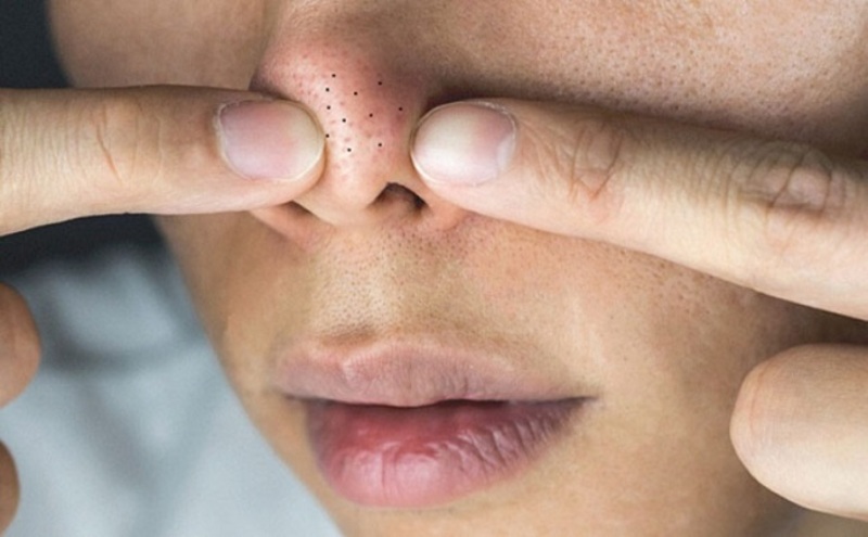 Chăm sóc da mụn đầu đen đơn giản mà hiệu quả 7 Không nên tự ý nặn mụn đầu đen (Nguồn: Internet)