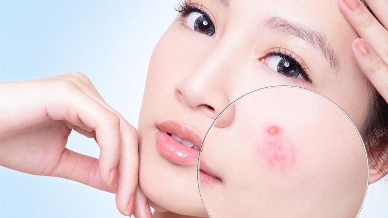 Cách chăm sóc da mụn nang để hạn chế sẹo rỗ 5 Mụn nang là gì? (Nguồn: Internet)