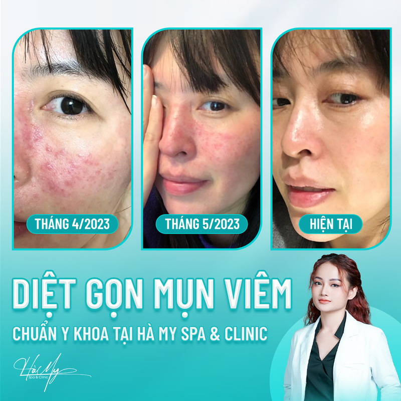Cách chăm sóc da mụn nang để hạn chế sẹo rỗ 8 Hình ảnh điều trị mụn ( Nguồn: Hamy Spa)
