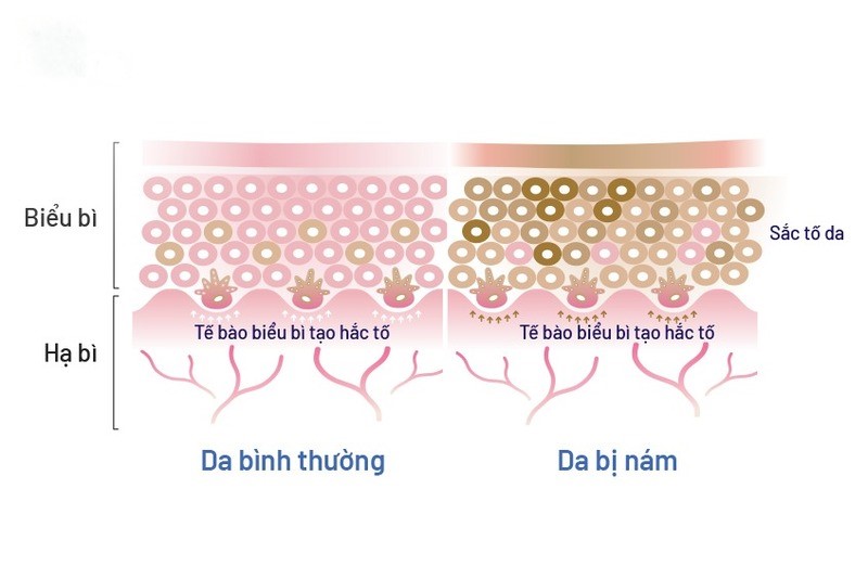 Cơ chế điều trị nám bằng hoạt chất 7 Nám da và quá trình hình thành nám da (Nguồn: Internet)