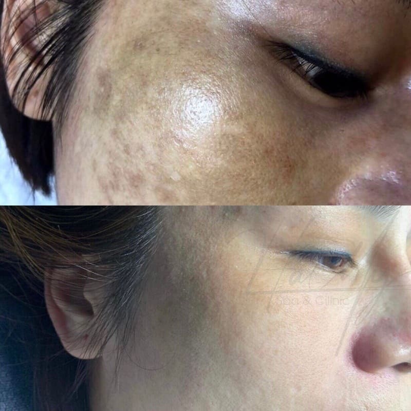 Cơ chế điều trị nám bằng hoạt chất 12 Công nghệ điều trị nám tận gốc không đau, không xâm lấn tại Hà My Spa (Nguồn: Hà My Spa)