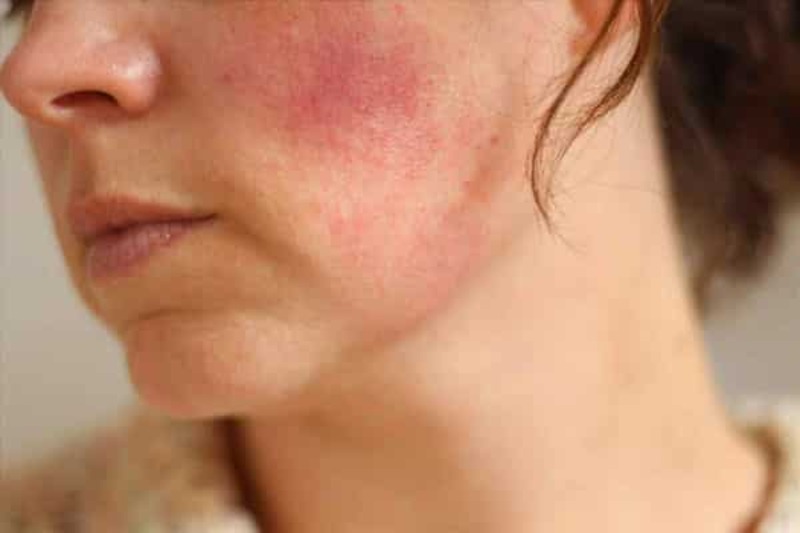 Thuốc Corticoid là gì? Có hại cho da không? 6 Corticoid giúp giảm viêm và sưng tấy (Nguồn: Internet)