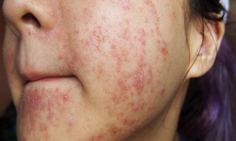 Thuốc Corticoid là gì? Có hại cho da không? 7 Tác dụng phụ khi dùng quá liều thuốc Corticoid (Nguồn: Internet)