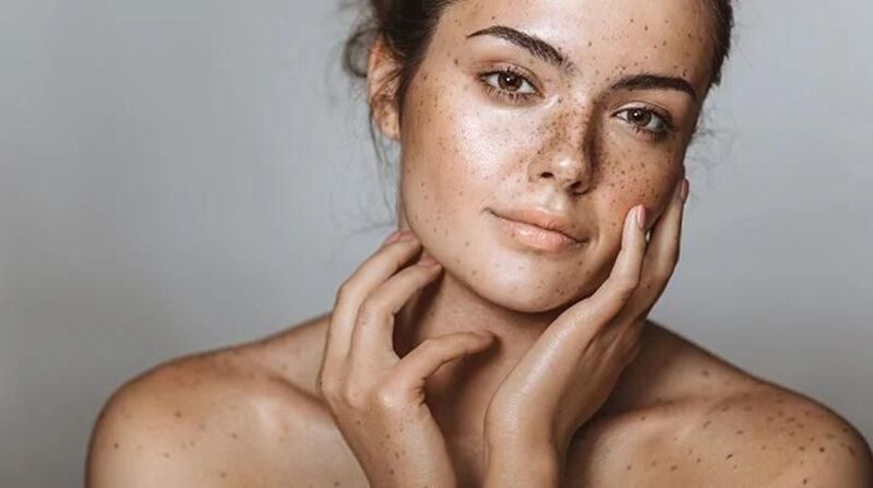8 Cách điều trị nám bằng lá trầu không đơn giản hiệu quả 7 Dấu hiệu bạn bị nám da (Nguồn: Internet)