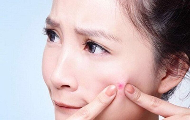 Cách Gom Cồi Mụn Nhanh Chóng An Toàn Hiệu Quả 9 Không nên nặn mụn có thể làm tăng nguy cơ nhiễm trùng (Nguồn: Internet)