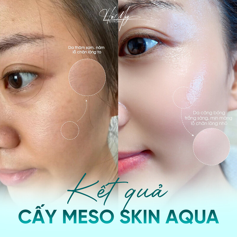 Công nghệ Meso Skin Aqua phương pháp làm đẹp da an toàn 5 Meso Skin Aqua là một công nghệ làm đẹp da tiên tiến (Nguồn: Hà My Spa)