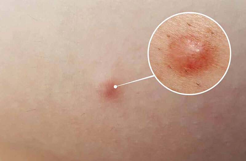 Mụn cục cứng dưới da - Nguyên nhân và cách điều trị 6 Mụn cục cứng dưới da thường khó điều trị (Nguồn: Internet)
