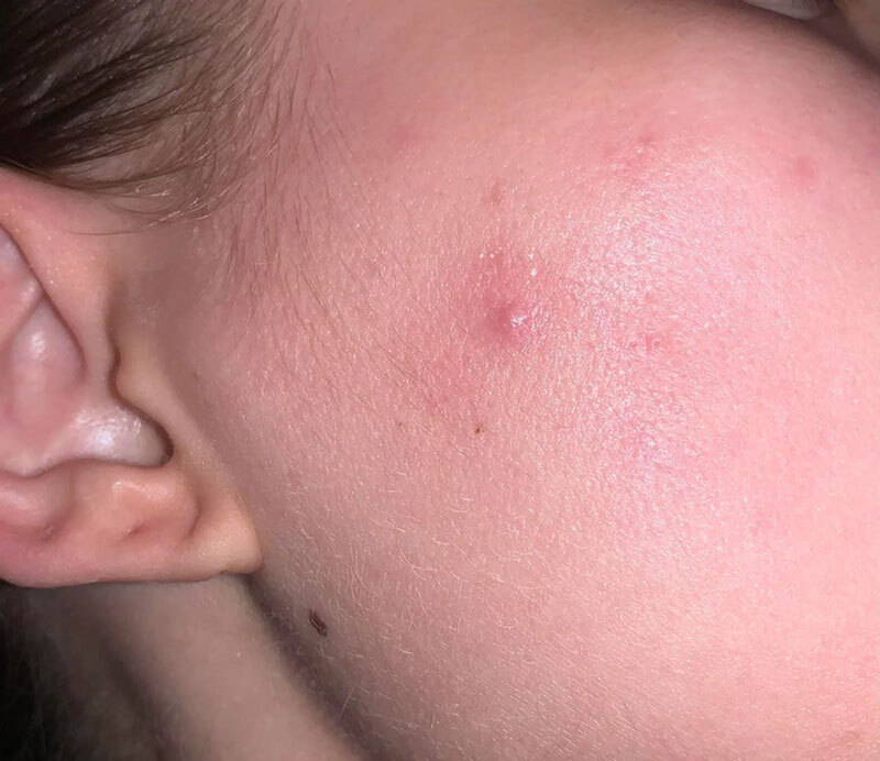 Mụn cục cứng dưới da - Nguyên nhân và cách điều trị 7 Có nhiều nguyên nhân gây ra mụn cục cứng dưới da (Nguồn: Internet)