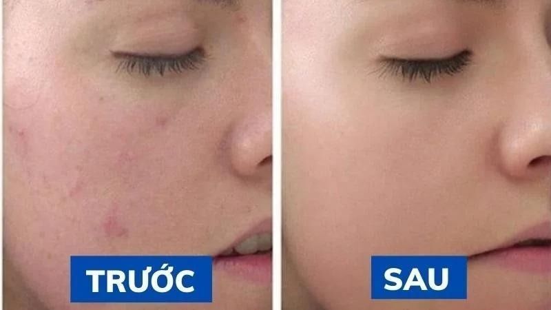 Mụn cục cứng dưới da - Nguyên nhân và cách điều trị 10 Hà My Spa giúp bạn có làn da mịn màng sau khi điều trị mụn (Nguồn: Hà My Spa)