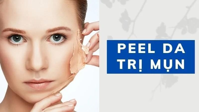 Bị Mụn Có Peel Da Được Không? Hướng Dẫn An Toàn 5 Bị mụn có peel da được không